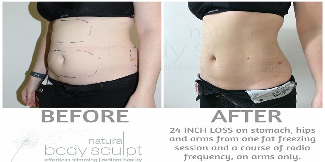 Cryolipolysis: Freezing Away Unwanted Fat for a Sculpted Physique